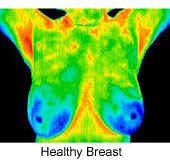 A digital infrared thermal image (DITI) showing a healthy breast