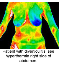 Digital Infrared Thermal Imaging (DITI)