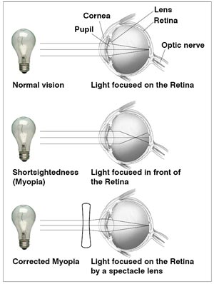 hyperopia myopia short sightedness