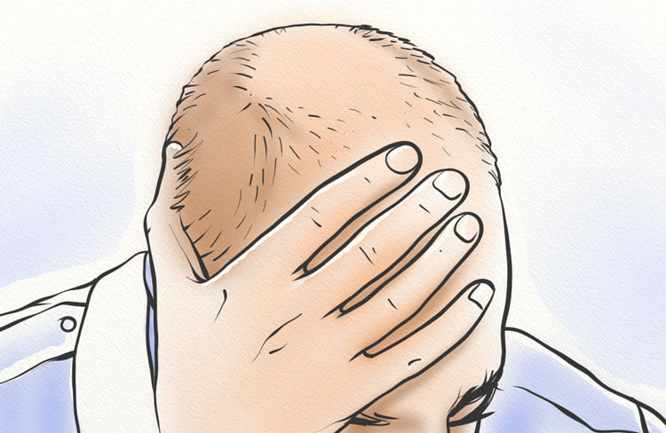 8 Things You Can do to Treat and Prevent Male Hair Loss