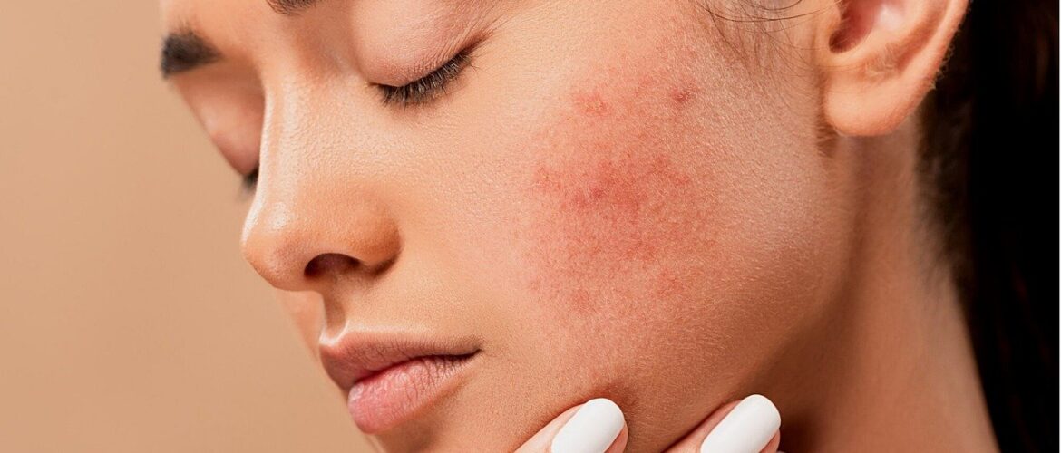 How To Effectively Manage And Treat Acne