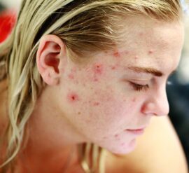 acne - more than skin deep? A whole body approach is encouraged