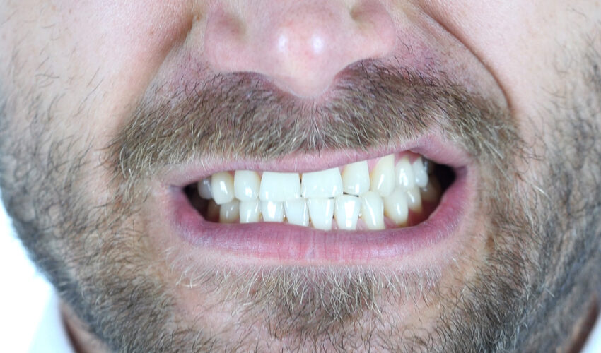 Bruxism: What You Need Know When Coping With Teeth Grinding