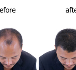 This picture shows the reasons why people get hair transplants