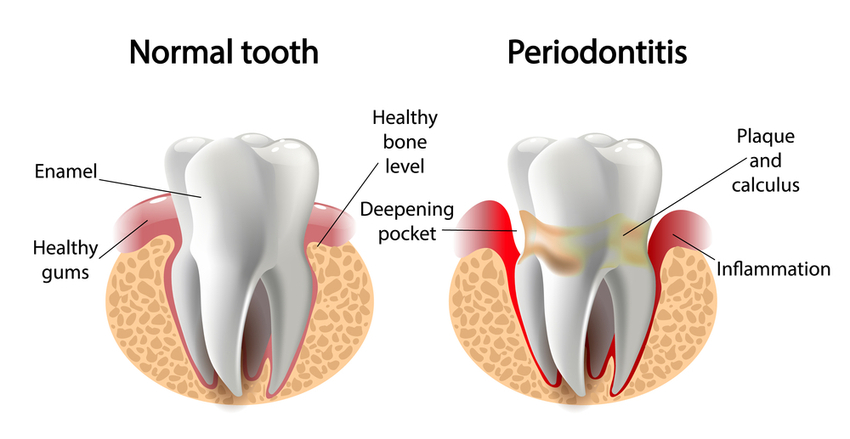 symptoms and treatment of gum disease, known as periodontitis