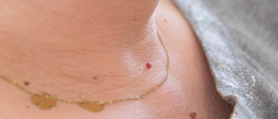 Should skin tags be removed? No, they are harmless, but you could get them removed if they are creating a problem