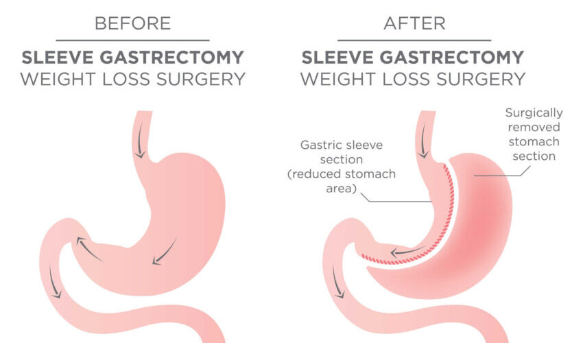 Stomach pain after gastric sleeve surgery is quite a common occurence