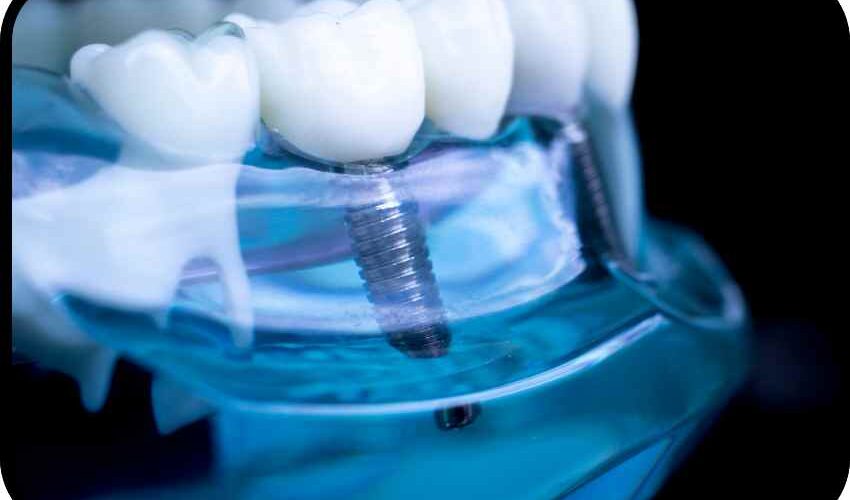 One of the benefits of dental implants is that are stronger and look more natural