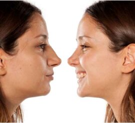 Consider the process carefully before you embark on either functional or cosmetic rhinoplasty